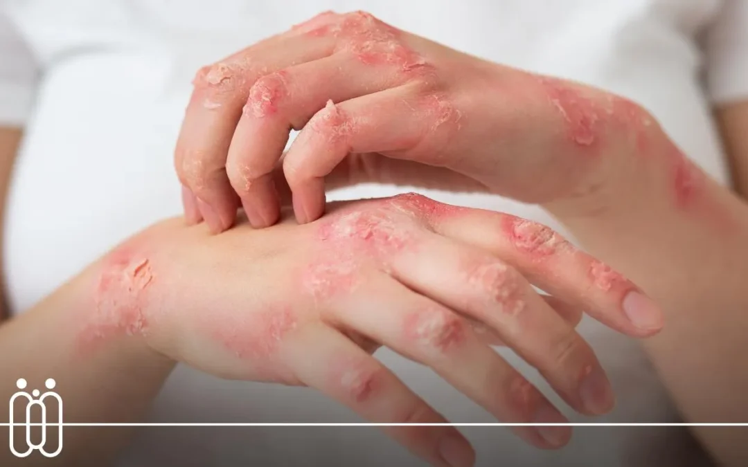 أكزيما الجلد، أسبابها وعلاجها
