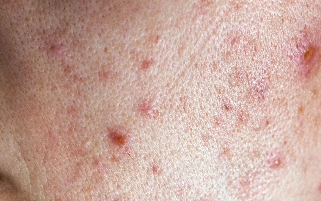 ما هو علاج حب الشباب المناسب لبشرتي؟ 